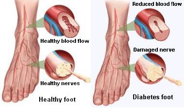Infezioni del piede