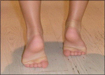 Benign acute childhood myositis Benign acute childhood myositis