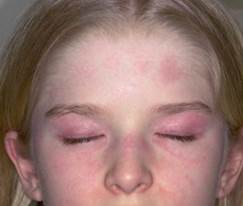heliotrope rash heliotrope rash