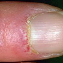 Changes in the nailfolds of the fingers Changes in the nailfolds of the fingers