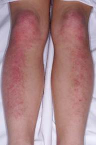 Erythematous Erythematous