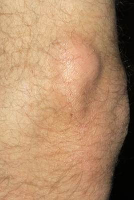 Subcutaneous calcinosis Subcutaneous calcinosis