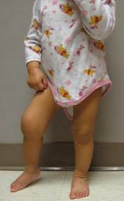 Juvenile rheumatoid arthritis Juvenile rheumatoid arthritis