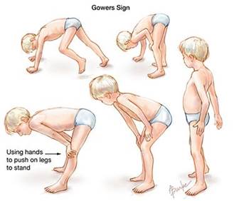 Muscular dystrophy Muscular dystrophy