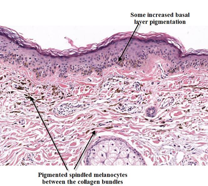 Nevus of Ota