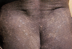 Oncocercosi Oncocercosi