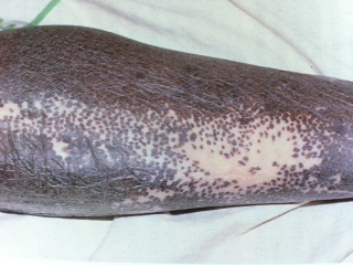 Oncocercosi Oncocercosi