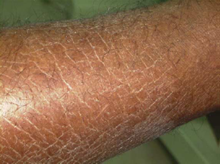 Oncocercosi Oncocercosi