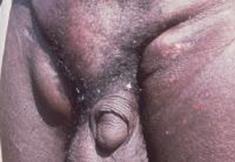 Oncocercosi Oncocercosi