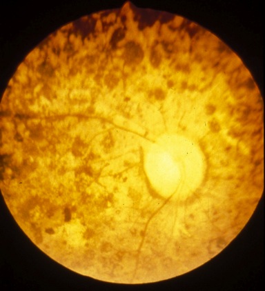 Oncocercosi Oncocercosi