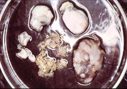 Oncocercosi Oncocercosi