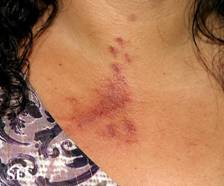 Paederus dermatitis