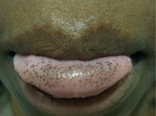 Pigmented papillae of the tongue