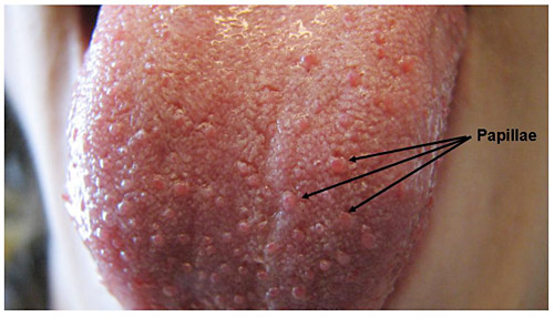 Pigmented papillae of the tongue