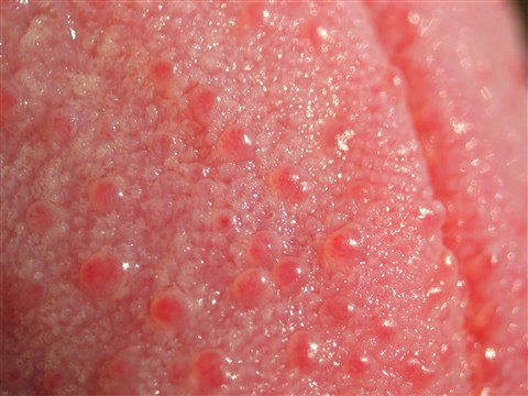 Pigmented papillae of the tongue