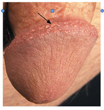 Pearly Penile Papules