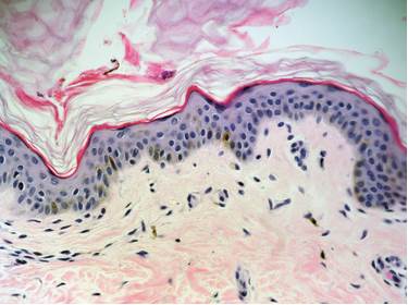 Progressive macular hypomelanosis