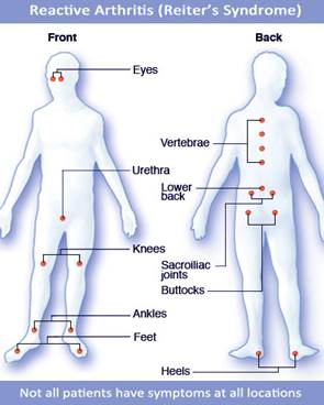 Reiter syndrome