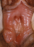 Sifiloma della vulva Sifiloma della vulva