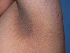 Acanthosis nigricans