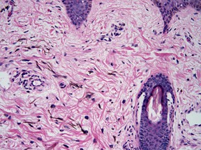 Acquired bilateral nevus of Ota-like macules