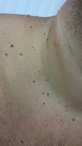 Image of Acrochordon acrochordon