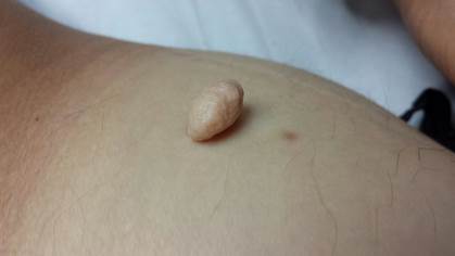 Image of Acrochordon Actinic granuloma