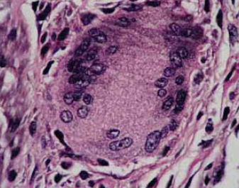 granuloma anulare granuloma anulare
