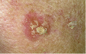 actinic keratoses