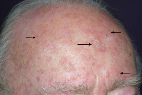 actinic keratoses