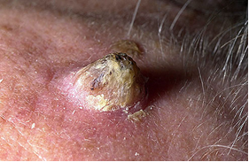 actinic keratoses