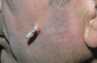 Image of Actinic keratoses actinic keratoses