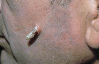 actinic keratoses