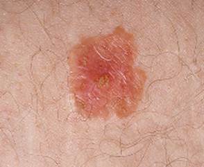 Image of Actinic keratoses actinic keratoses