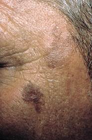Image of Actinic keratoses actinic keratoses