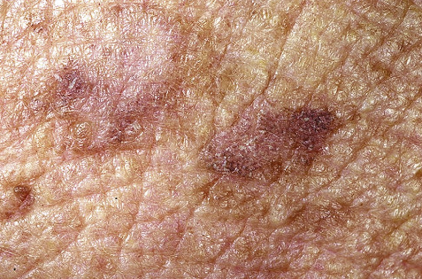 actinic keratoses