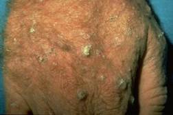 Image of Actinic keratoses actinic keratoses