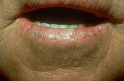 Image of Actinic keratoses actinic keratoses