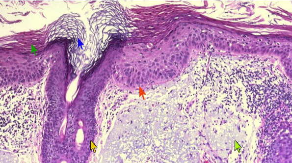 actinic keratoses