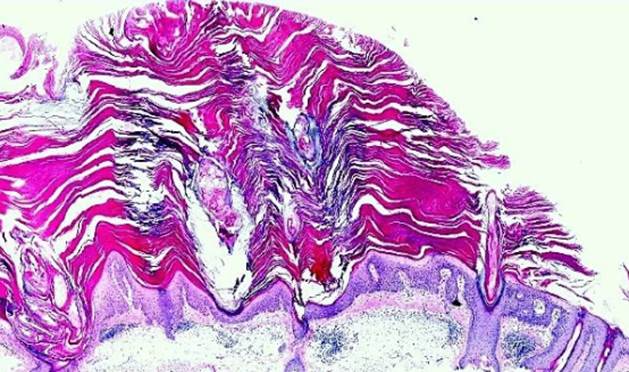 actinic keratoses