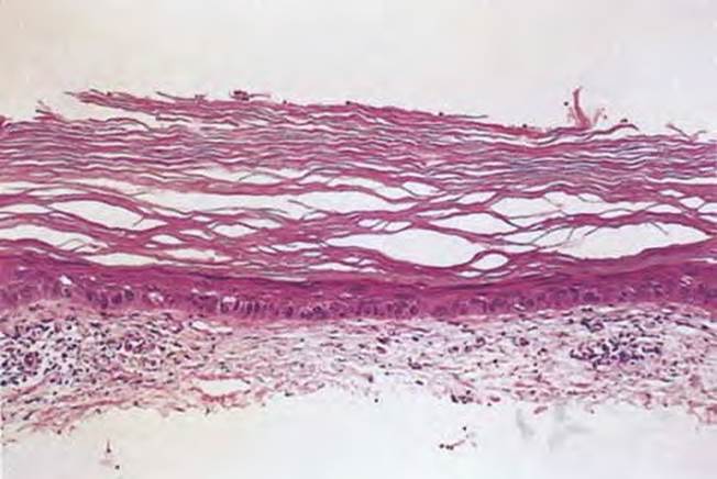 actinic keratoses