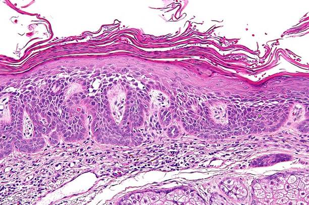 actinic keratoses