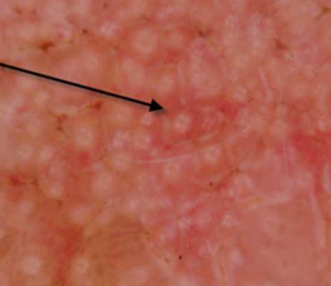 actinic keratinosis