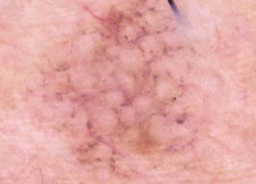 actinic keratinosis