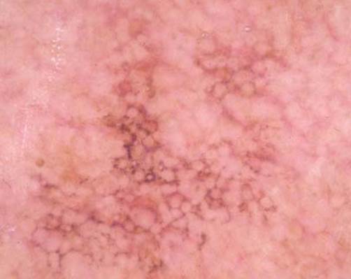 actinic keratinosis
