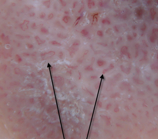 actinic keratinosis