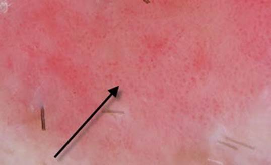 actinic keratinosis