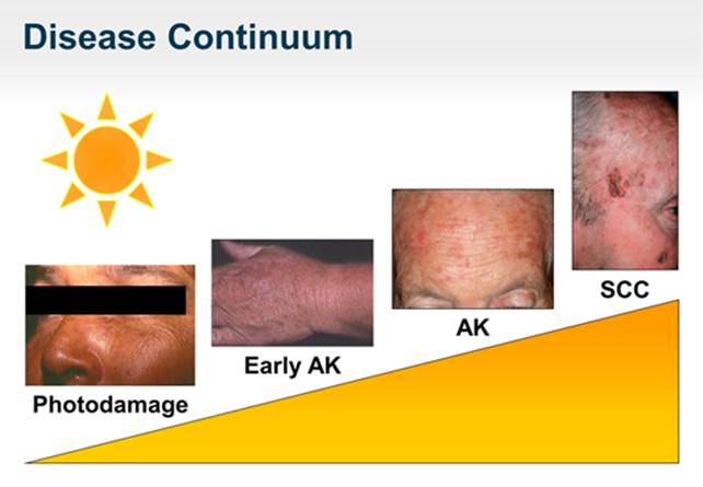 Actinic Keratosis Histology Dermatology At American University Of