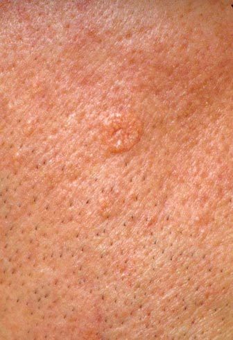 Immagine di un adenoma sebaceo Adenoma sebaceo
