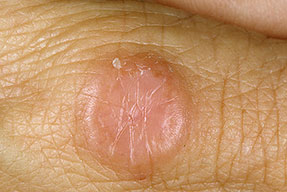 granuloma anulare